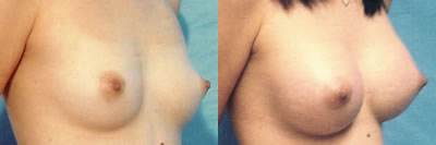 http://www.cosmetic-plastic-surgical-center.com/images/doctors/edween_gallery/photos/breastaug3.jpg