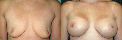 http://www.cosmetic-plastic-surgical-center.com/images/doctors/edween_gallery/photos/breastaug2.jpg